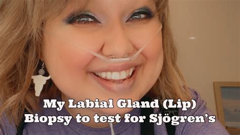 My Labial Gland Lip Biopsy To Test For Sjögrens Youtube
