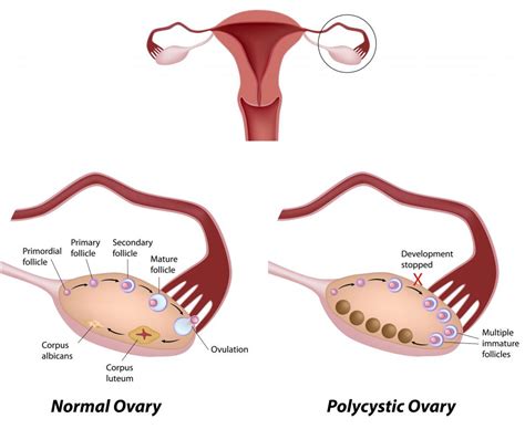 What Is A Septated Ovarian Cyst With Pictures