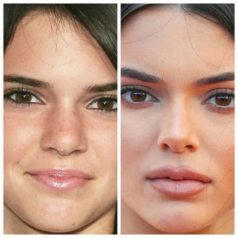 Kendall Jenner Plastic Surgery A Complete History Who Magazine Kendall Jenner Nose Job