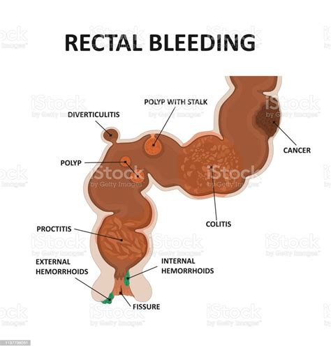 Cause Rectal Bleeding Stock Illustration Download Image Now Istock