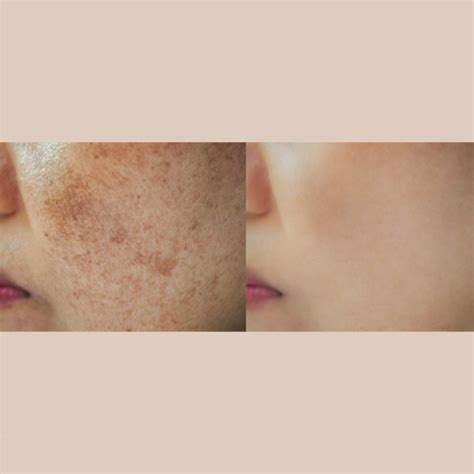 How To Get Rid Of Uneven Skin Tone 4 Step Guide Kama Ayurveda
