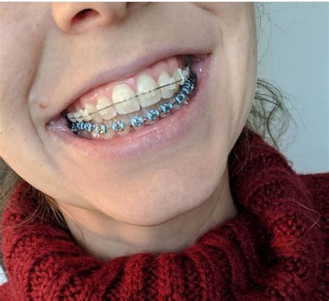 Pin By John Beeson On Orthodontic Braces In 2019 Orthodontie
