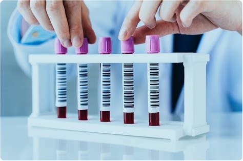 Un nouveau test sanguin peut détecter le cancer de la prostate et confirmer le stade de la maladie