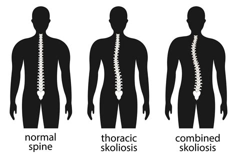 Vector Illustration Of Spinal Deformity Kyphosis Lordosis And