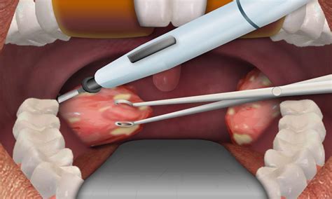 Tonsillectomy