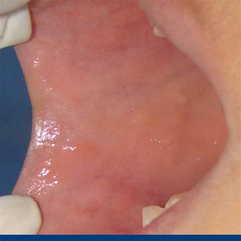 Multiple Papules Located In The Buccal Mucosa Labial And The Anterior