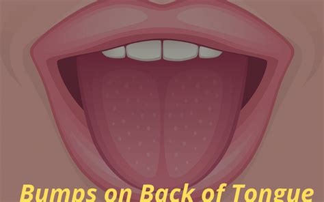 Bumps On Back Of Tongue Diagnosis Causes And Treatment And