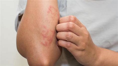 What Causes Eczema Scientists Blame It On Lack Of A Protein Skin