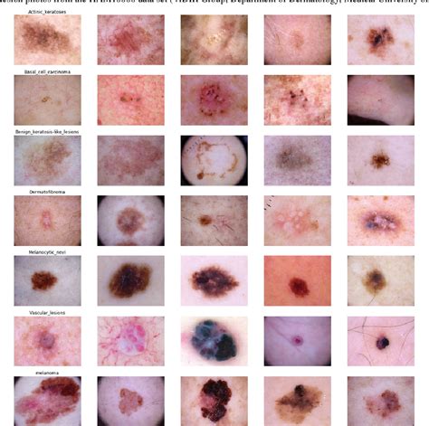 Figure 1 From Skin Lesion Classification With Deep Convolutional Neural