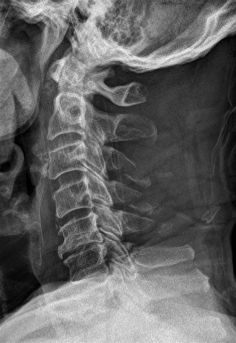 Fracture Luxation Et Entorse Du Rachis Cervical Thoracotomie