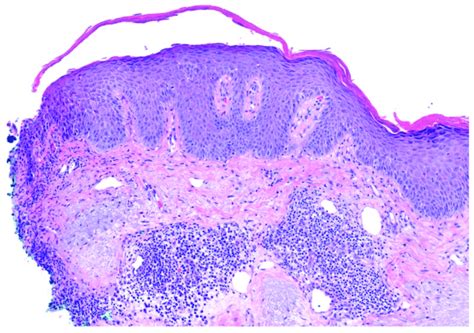 Pemphigus Foliaceus Superficial Acantholysis Within The Granular Layer