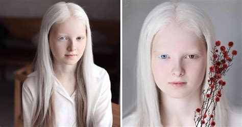 Photographer Captured The Unique Beauty Of A Girl With Albinism And Heterochromia