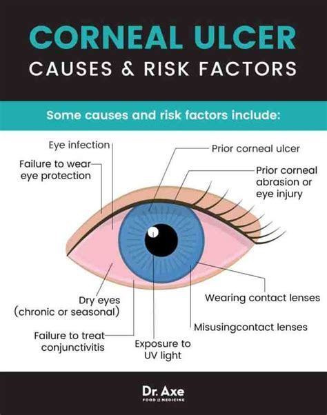 Corneal Ulcer Causes And Treatment Dry Eye Symptoms Dry Eye My XXX Hot Girl
