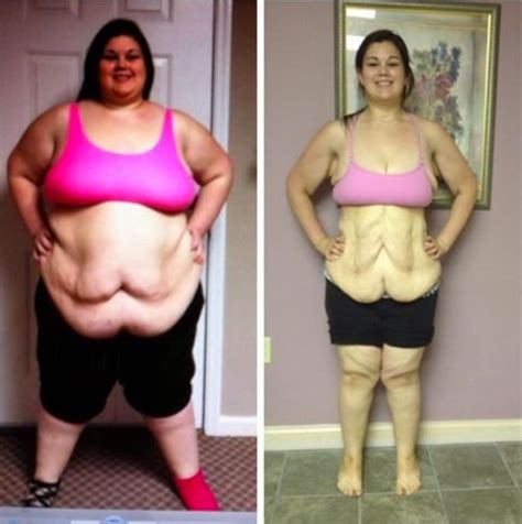 Your weight loss plan was successful, but you have excess skin. will insurance pay for skin removal after large weight loss | salegoods | Pinterest | Weight ...