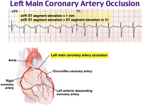 Left Main Coronary Artery Occlusion On Ecg Avr Grepmed