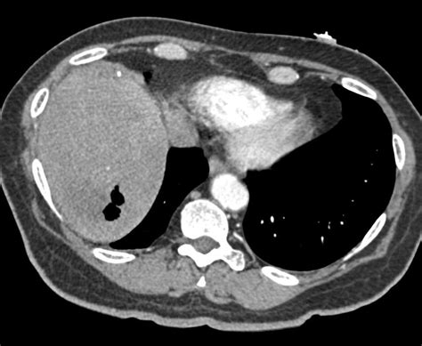 Liver Abscess With Air Liver Case Studies Ctisus Ct Scanning