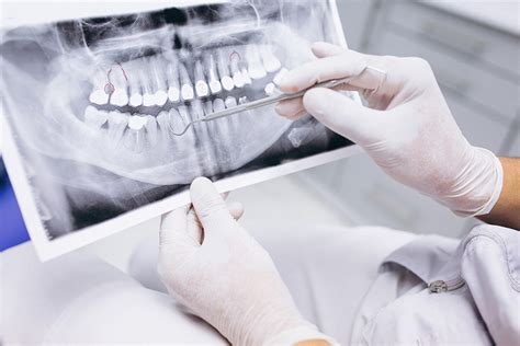 La Importancia De Las Radiografías Dentales Para Tu Diagnóstico Red