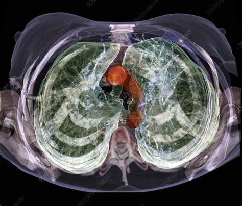 Healthy Lungs 3d Ct Scan Stock Image C0166504 Science Photo Library