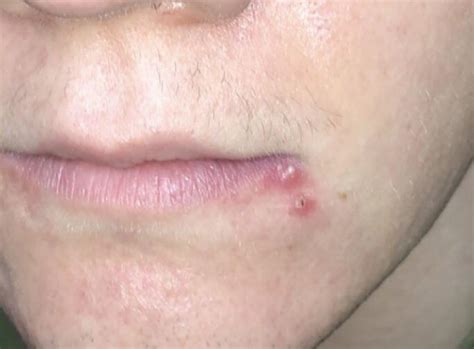 I Always Get Pimples Right Next To The Edge Of My Lips Have Been For 4