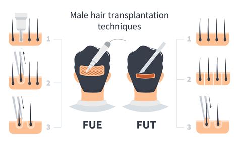 Male Hair Transplantation Fue And Fut Comparison Stages Of Follicular
