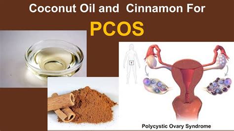Fish oil has been shown to lower testosterone in pcos women. Home Remedies For PCOS with Coconut Oil and Cinnamon - YouTube