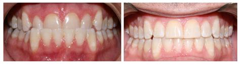 Invisalign Before And After Invisalign Treatment Transformation