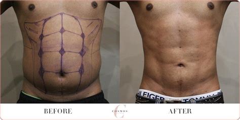Male Vaser Hi Def Liposuction Before And After Gallery