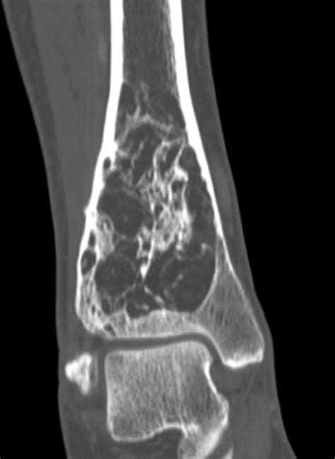 Expansive Unicameral Bone Cyst Occupying The Distal Tibia A Case