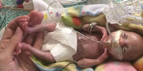 Most Premature Surviving Baby 21 Weeks Preemie Survives
