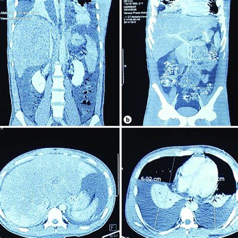 A Contrast Enhanced Abdominal CT Finding CT Image Shows Hepatomegaly