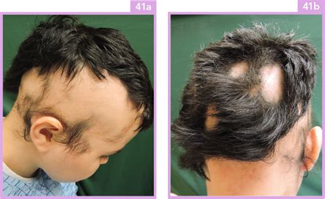 Oral cyclosporine for the treatment of alopecia areata. Alopecia areata | Plastic Surgery Key