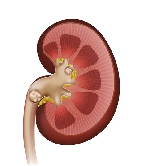 Kidney stones are a common cause of blood in the urine and pain in the kidney stones occur in 1 in 20 people at some time in their life. Kidney Stones Chattanooga TN | Kidney Stone Treatment ...