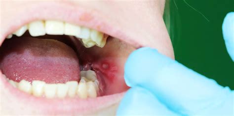 Youll Likely Get A Canker Sore 3 To 4 Times Per Year Heres What