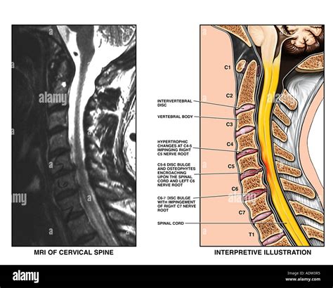 Whiplash Injury C4 5 C5 6 And C6 7 Cervical Intervertebral Disc