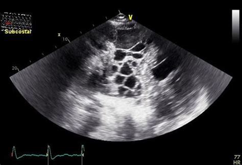 Fluid within the horizontal or oblique fissures 4. SOUTHWEST JOURNAL of PULMONARY & CRITICAL CARE - Imaging - Medical Image of the Week: Septated ...