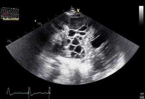 Learn about pleural effusion (fluid in the lung) symptoms like shortness of breath and chest pain. SOUTHWEST JOURNAL of PULMONARY & CRITICAL CARE - Imaging ...
