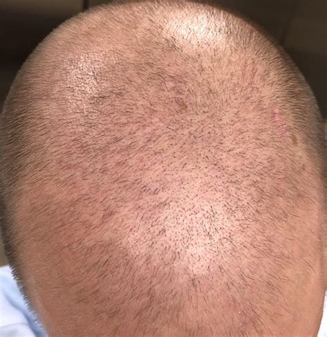 Seborrheic Dermatitis Hair Loss Reddit Debrah Morrell