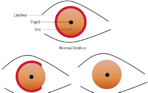 Schematic Of An Eye Showing A Normal Limbus Red Partial Limbal Stem