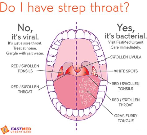 Strep Throat Fastmed Urgent Care