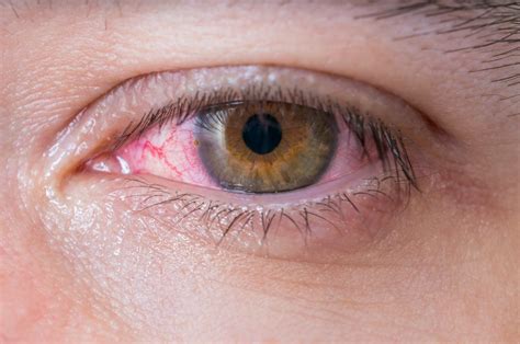 What Causes Itchy Eyes Digital Trends Report