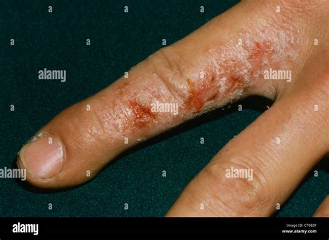 Dyshidrosis Stockfoto Bild 49183471 Alamy