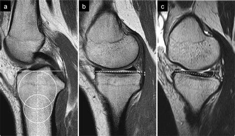 Magnetic Resonance Images Of A Knee With An Acl Injury A