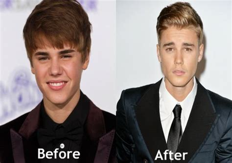 justin bieber plastic surgery before and after nose job nose job plastic surgery types of