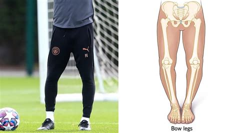 Why Do Footballers Have Bow Legs Causes Explained In Details
