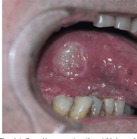 Figure 1 From Eosinophilic Ulcer Of The Oral Mucosa A Distinct Entity