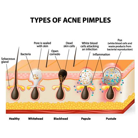 The Different Types Of Acne Which One Do You Have