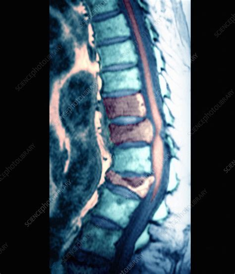 Bone Cancer Spinal Mri Scan Stock Image M1340476 Science Photo