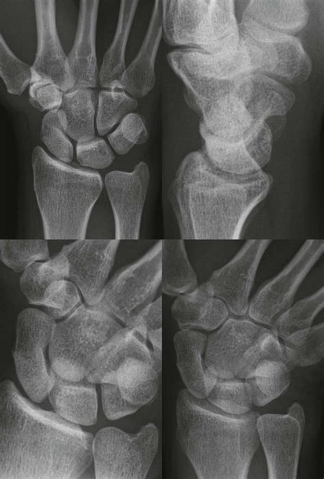 Wrist And Distal Forearm Radiology Key