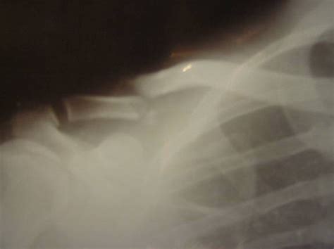 Chads Broken Collar Bone Report Hans Kellner Dot Com