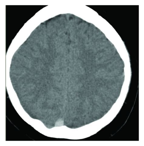 Unenhanced Ct Scan Of The Head A Showing Acute Hyperdense Thrombus